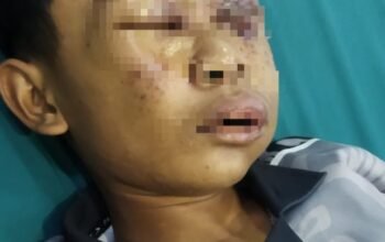 Dugaan Kekerasan, Wajah Santri Kayong Utara Lebam, Pengurus Ponpes Labbaik Indonesia Kubu Raya Sebut itu Cuma Alergi Obat Jenis Parastamol